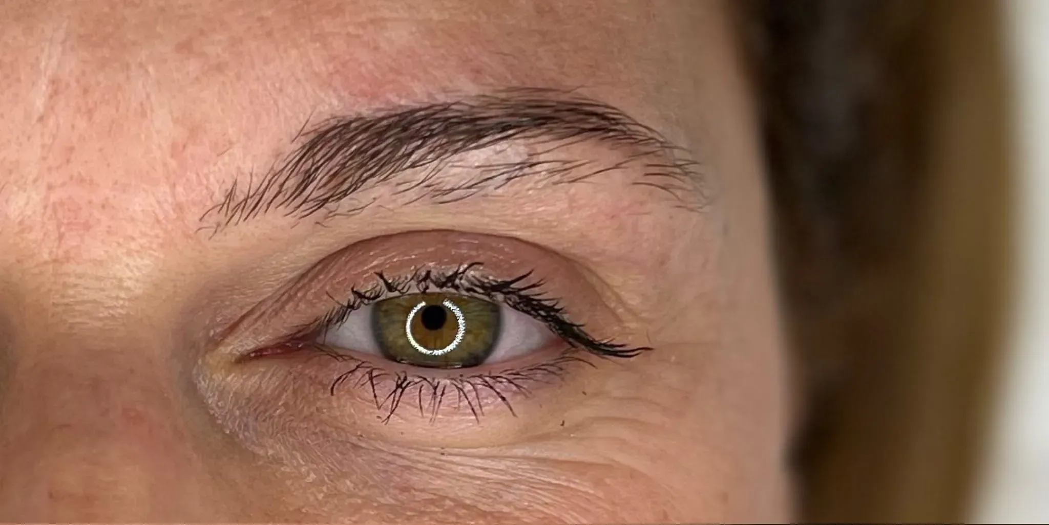 Rigenerazione Arcata Sopracciliare - Prima